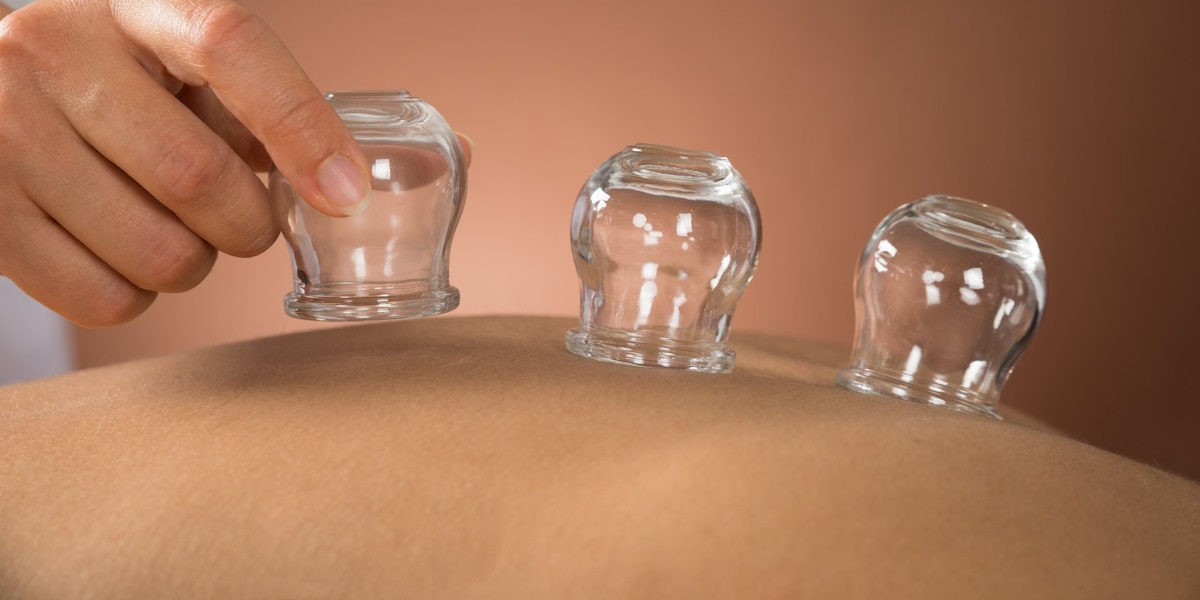 Chinese Cupping